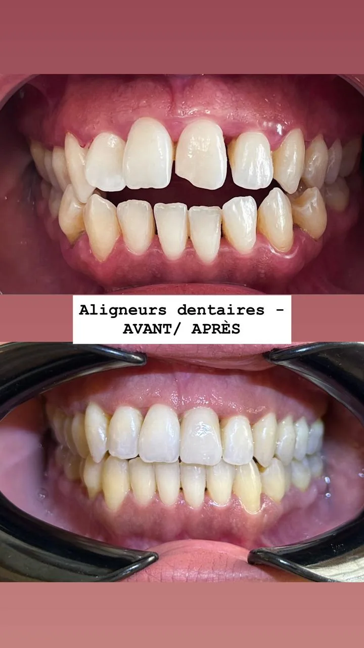 Couronne sur implant réalisée au cabinet
