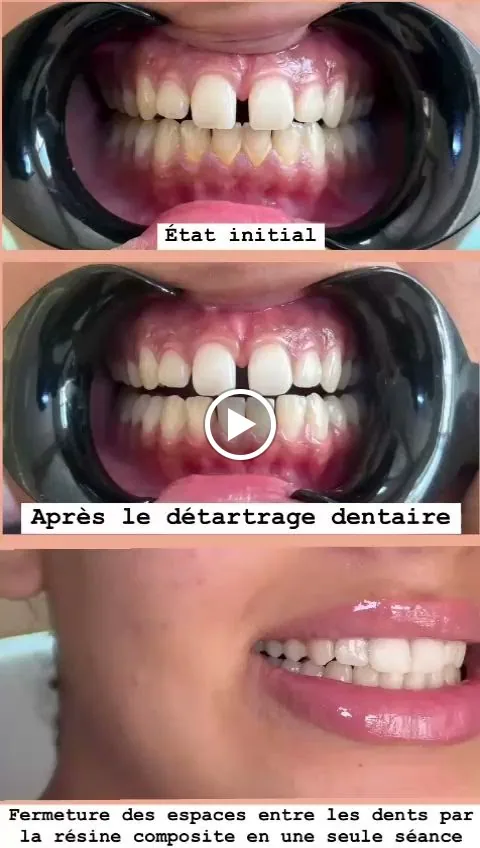 Aligneurs dentaires — avant / après